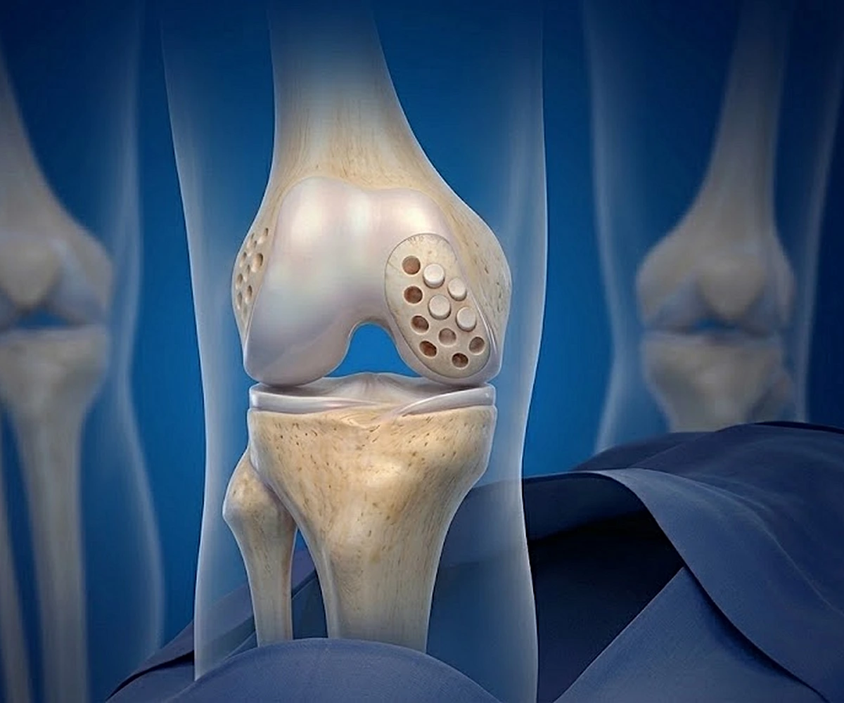 Lesioni cartilaginee