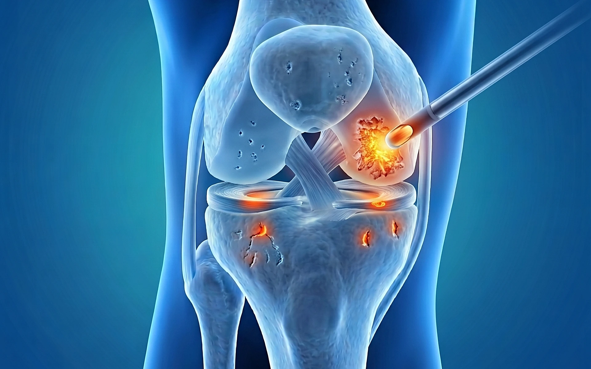 Lesioni cartilaginee